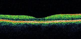 normal OCT retinal image