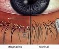 Blepharitis