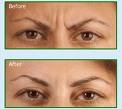 An example of before and after a Botox treatment between the brows