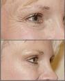 An exaple of a Botox treatment for crow's feet