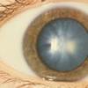 Cataract