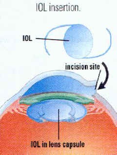 The new implant lens is inserted into the eye