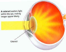 A clody lens scatters light rays