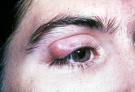 External chalazion