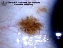 Pigmented conjunctival nevus