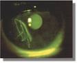 Corneal abrasion