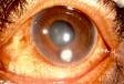 Focal infiltrate of the cornea