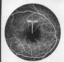 Normal retina with dye inside the vessles