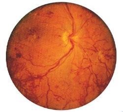 New abnormal blood vessels (sqiggly red lines) growing means proliferative retinopathy