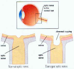 Optic nerve damage or "cupping"