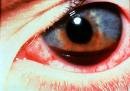 Bleeding inside the anterior chamber