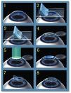 The Basic steps of LASIK