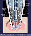 microdermabrasion tip action