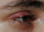 Stye of the eyelid