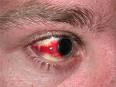 Subconjunctival hemorrhage