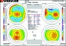 Topography or corneal surface map