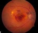 central retinal bleed