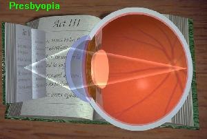 The focus point moves behind the retina as the object is pulled near and the focus unit can't adjust